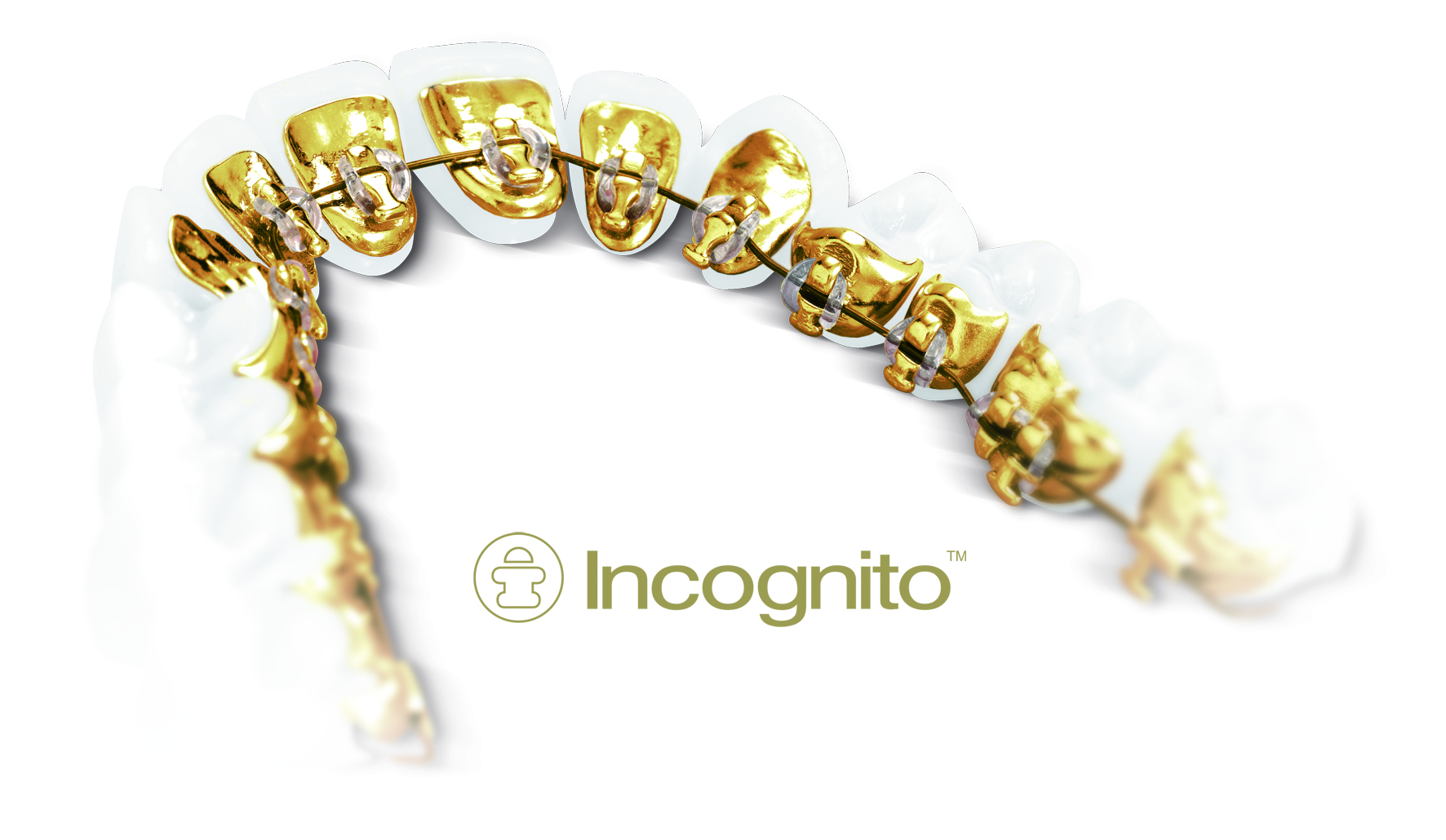 Знакомство с механикой лечения на системе Incognito (случаи без удаления и с удалением зубов)